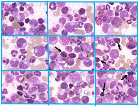 Cancers | Special Issue : Chronic Myeloid Leukemia