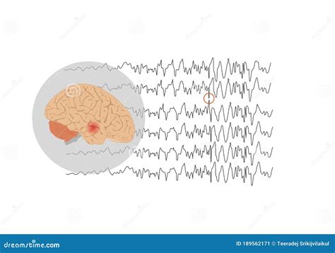 Focal Seizure Originating from Temporal Lobe Stock Vector - Illustration of backgrounds, pattern ...