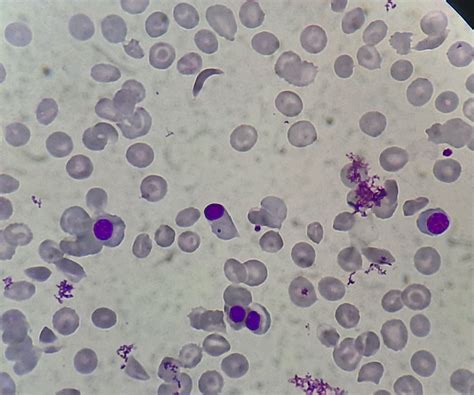 Sickle Cell Anemia - howitreat.in