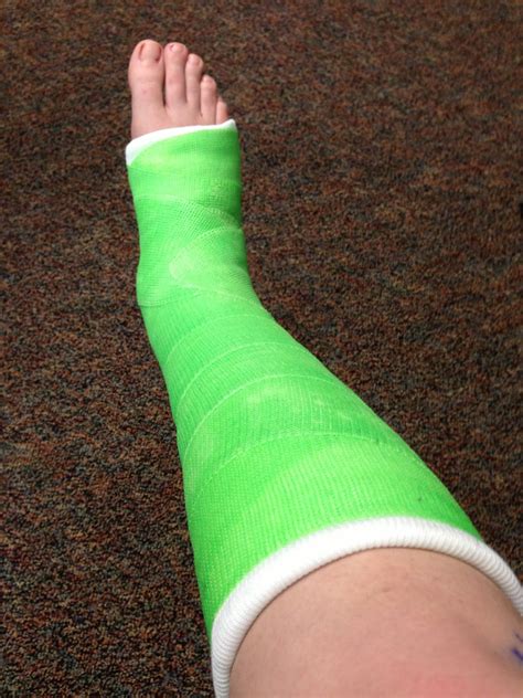 Fractured Cast Foot at Alison Mclemore blog