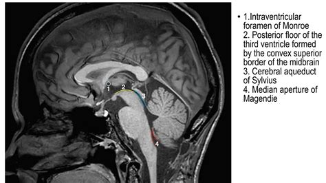 cerebral cisterns for radiology dnb .pptx