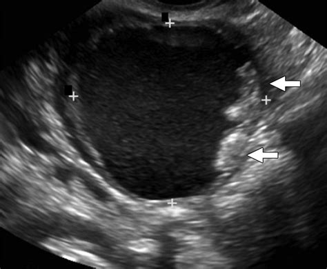Ovarian Cancer Transabdominal Ultrasound