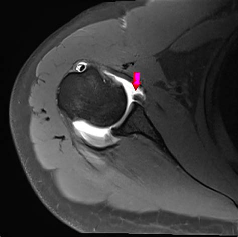 MRI-Labral-tear-shoulder-dislocation-dr-Sujit-Jos-1 - Docjoints | Dr. Sujit Jos – Expert ...