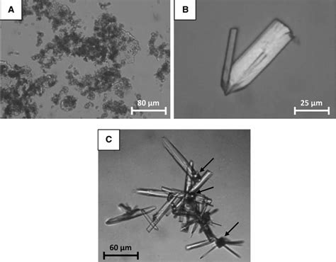 Crystals in urine cause, what does it mean to have crystals in urine