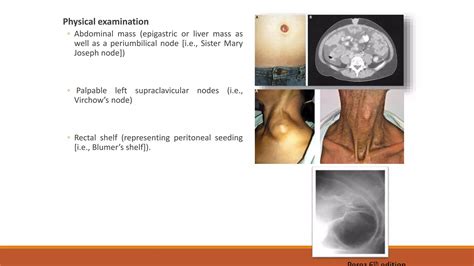 Role of Radiation Therapy in gastric cancer | PPTX