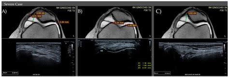 Patello-Femoral Pain Syndrome: Magnetic Resonance Imaging versus Ultrasound