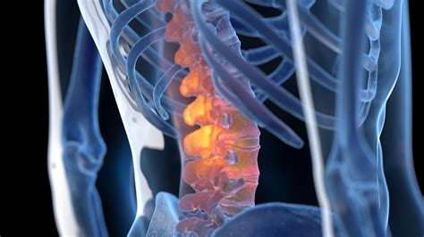 Lesiones Medulares Incapacidad Permanente Por Lesiones Medulares