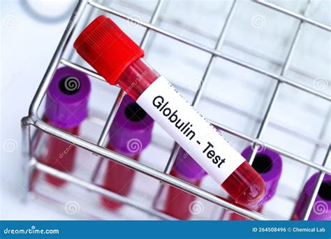 Globulin Test To Look for Abnormalities from Blood Stock Photo - Image ...