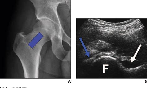 How to Perform Hip Ultrasound 的图像结果