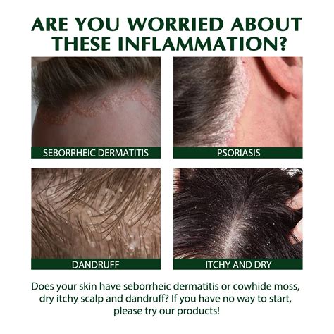 Mild Eczema Scalp