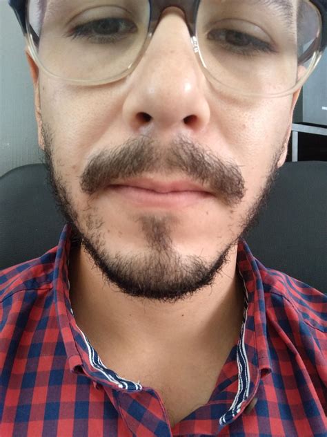 Do i have potential if i use minoxidil? 28 yo, mexican,my father have a ...