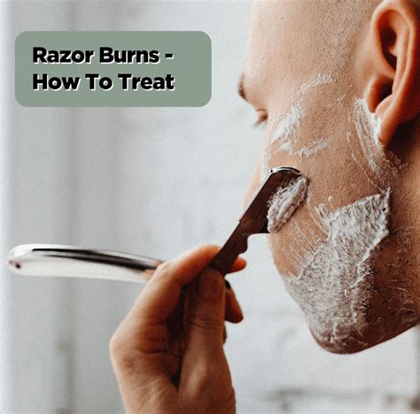 Treating Razor Burns – SGPomades