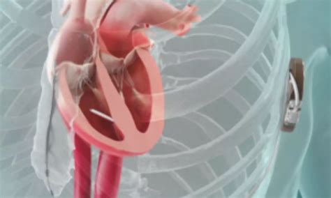 Breakthrough in Cardiac Care: Leadless Pacemaker-ICD System Exceeds ...