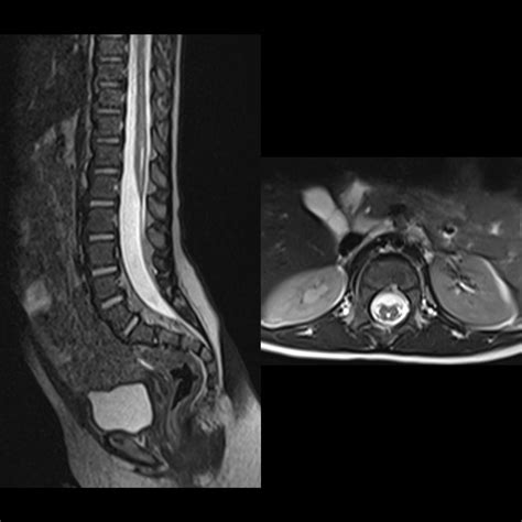 Toddler with a sacral dimple | Pediatric Radiology Case | Pediatric Imaging | @pedsimaging ...