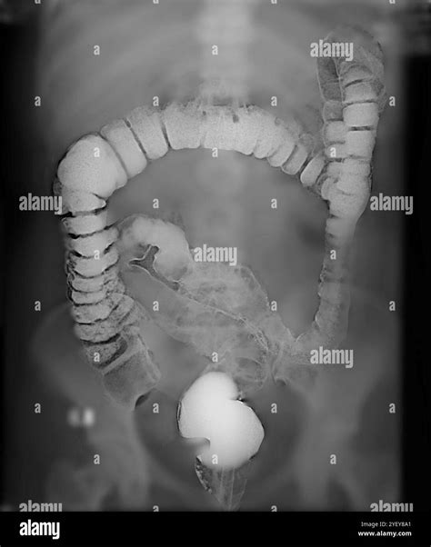 Frontal X-ray of a healthy colon (large intestine). The colon is the final part of the digestive ...