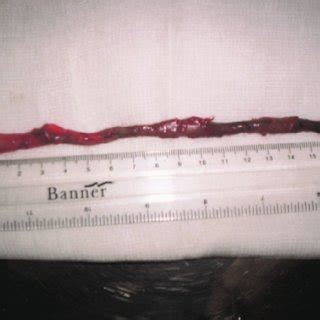 Image result for Dissected Appendix