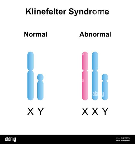 Klinefelter syndrome hi-res stock photography and images - Alamy