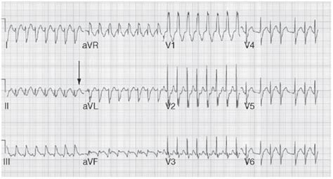 Image result for AFib Detection Algorithm