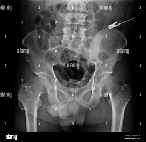 Pelvis x ray hi-res stock photography and images - Alamy
