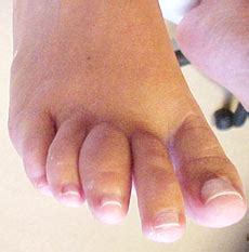 Women Fitness: Hallux Rigidus: a Degenerative Toe Arthritis