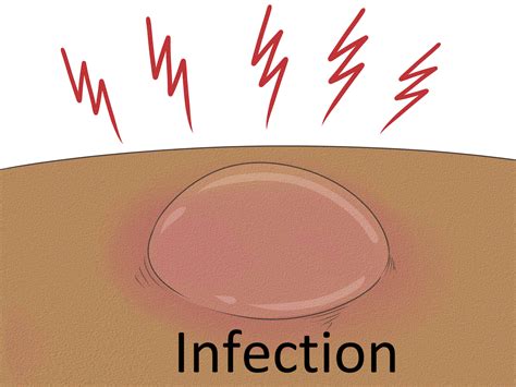 Pop a Blister? When It's Safe and How to Do It