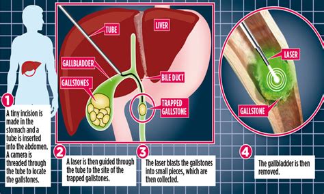 Gallbladder Stones Operation Gallstone Surgery: What Are The Risks?