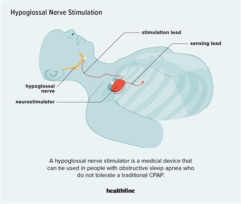 Sleep Apnea Implant: Pros, Cons, How It Works, Effectiveness