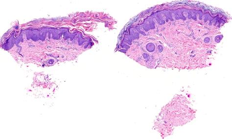 Dermatopathology Society of India: Image of the Month