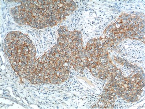 Breast Cancer Awareness Month | Proteintech Group