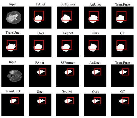 RMTF-Net: Residual Mix Transformer Fusion Net for 2D Brain Tumor ...