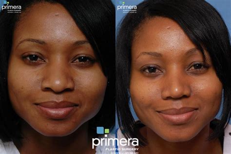 Rhinoplasty Before and After Pictures Case 11 | Orlando, Winter Park & Tampa, Florida | Primera ...