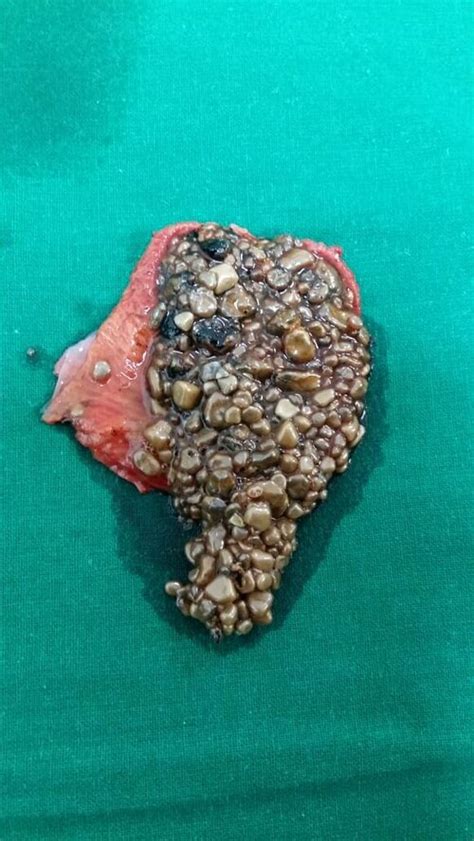 Removal of More than 150 gallbladder stones by Dr. Mandar Dhamangaonkar ...