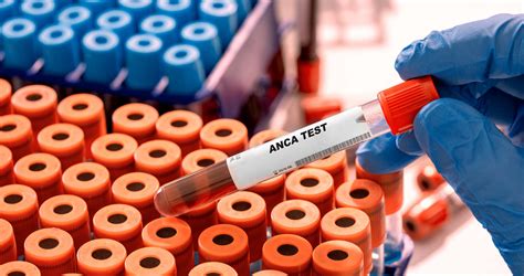 ANCA-Associated Vasculitis Testing - Rare Disease Advisor