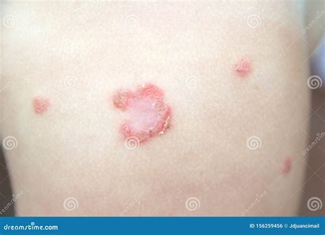 Bacterial Rash Treatment