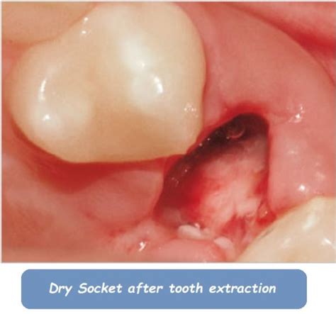 Image result for Tooth Extraction Dry Socket
