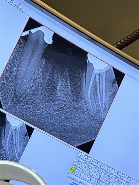 Image result for Abscess Tooth Extraction