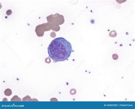 Lymphoma Diffuse Large Cell