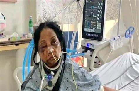 अमेरिका में मरीज ने भारतीय नर्स पर किया हमला, चेहरे की हड्डियां तोड़ीं ...