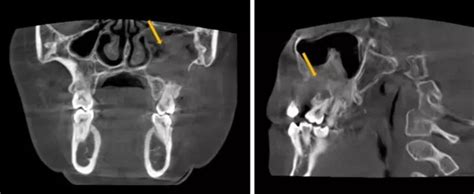 Compared to panoramic radiography, CT/CBCT has significantly higher ...