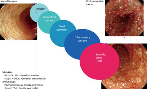 Colitis Vs. Cancer 的图像结果