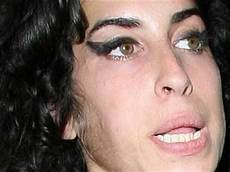 Downy Hair Anorexia by Medusa Anorexia Bulimia That Downy Hair Is Called Quot Lanugo Quot Downy Hair Anorexia