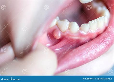 Close-up of a Problem into Kids Mouth. Blister, Pustule on the Gums of a Milk Teeth of a Small ...
