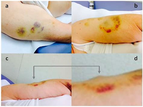 A Neglected Complication of Insulin Therapy Due to Errors in Injection ...