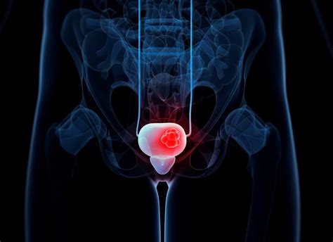 Radical Dose RT Produces Similar Outcomes as RC in cN+ M0 Bladder Cancer- Cancer Therapy Advisor