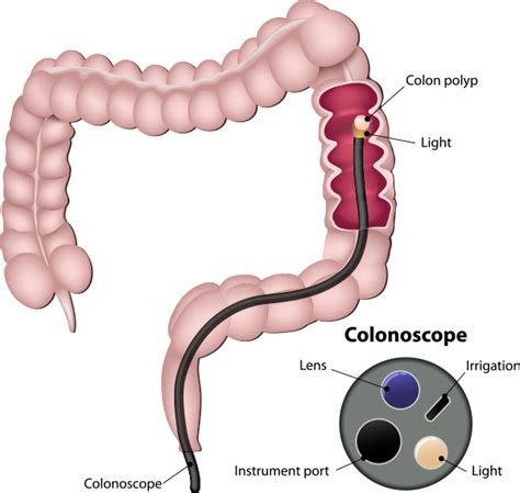 Colonoscopy 的图像结果