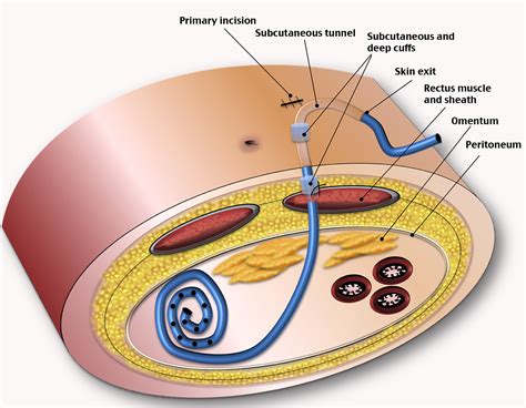 Peritoneal Dialysis Catheter Surgeon at Sabrina Patterson blog