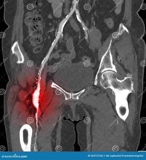 CTA Femoral Artery Run Off Image of Femoral Artery for Diagnostic Acute or Chronic Peripheral ...