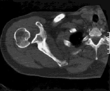 Image result for Step and Sulcus Sign