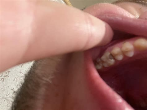 Image result for Tooth Hole