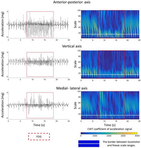 Towards Real-Time Detection of Freezing of Gait Using Wavelet Transform ...
